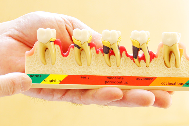 歯周病のメンテナンス治療