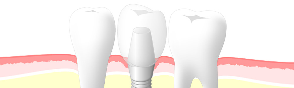 インプラント