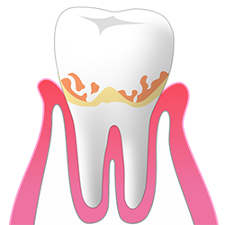 軽度の歯周病