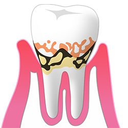 中等度の歯周病