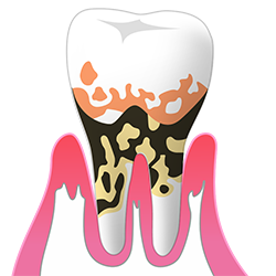 重度の歯周病